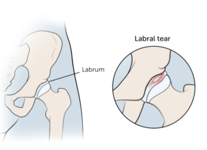 two types of labral tears