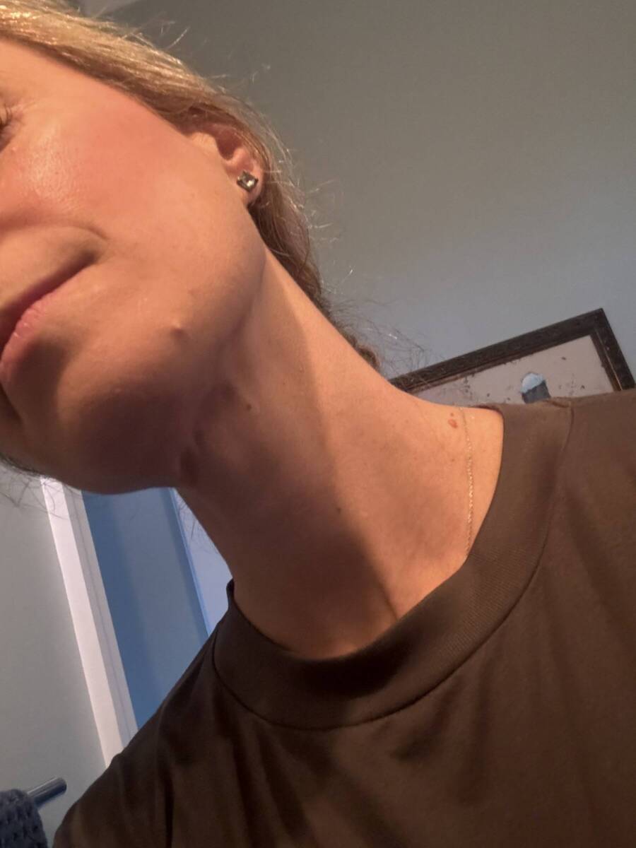 Woman with pimple on chin